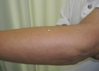 実際に置く“もぐさ”の大きさです。